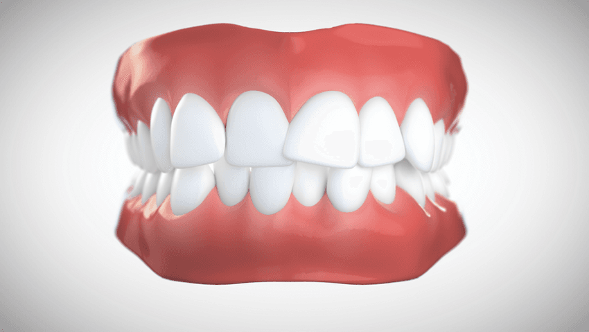 Encombrement dentaire