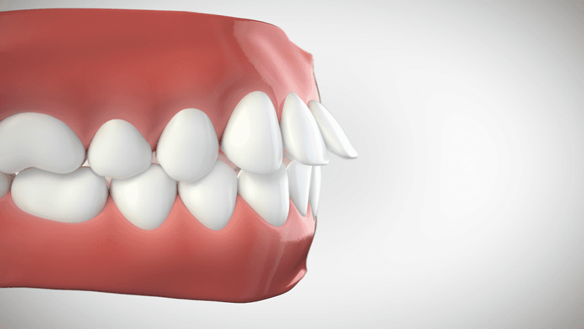 Surplomb incisif augmenté (overjet)